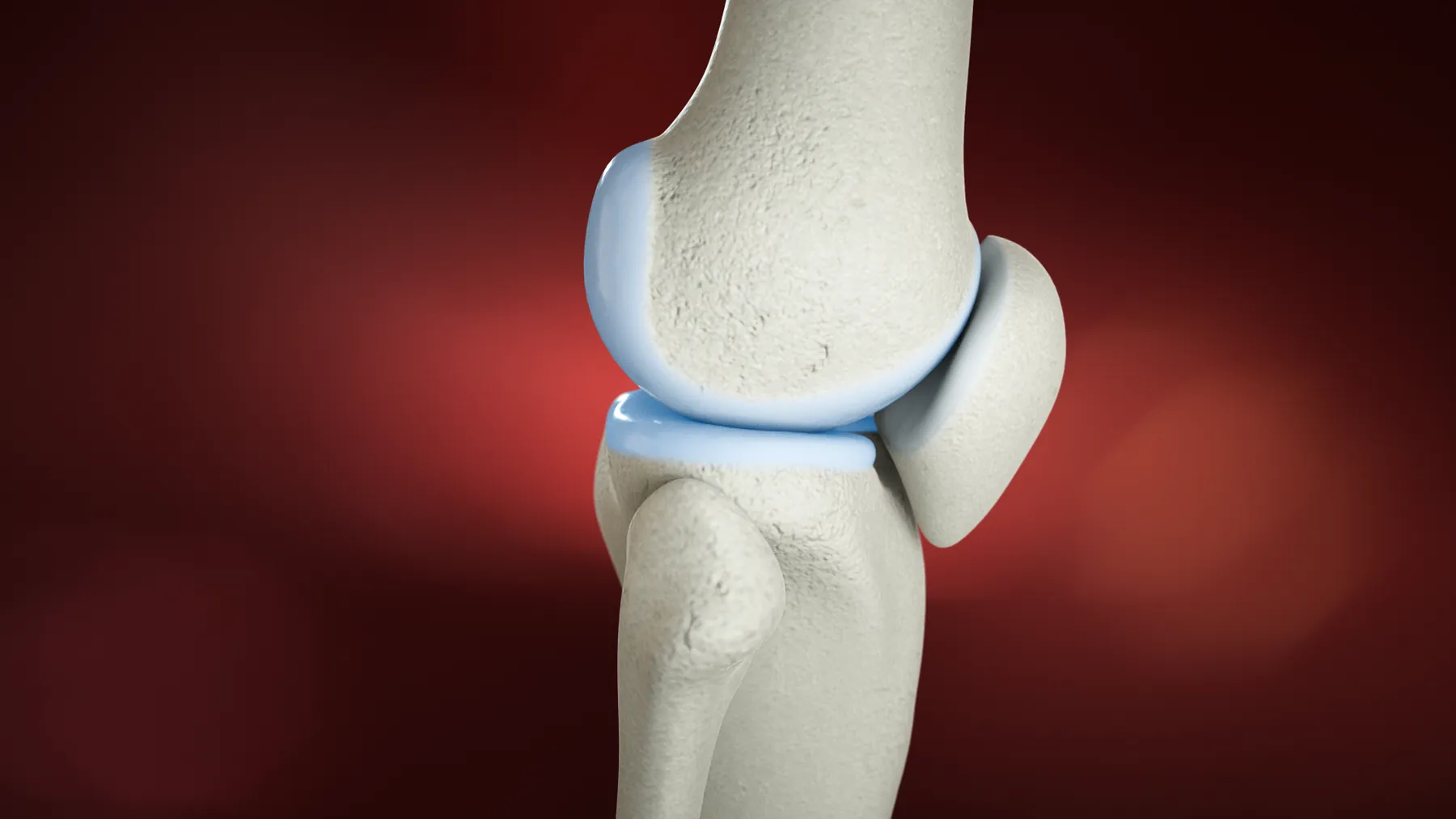 Tendoplus ACL Therapy — image 2