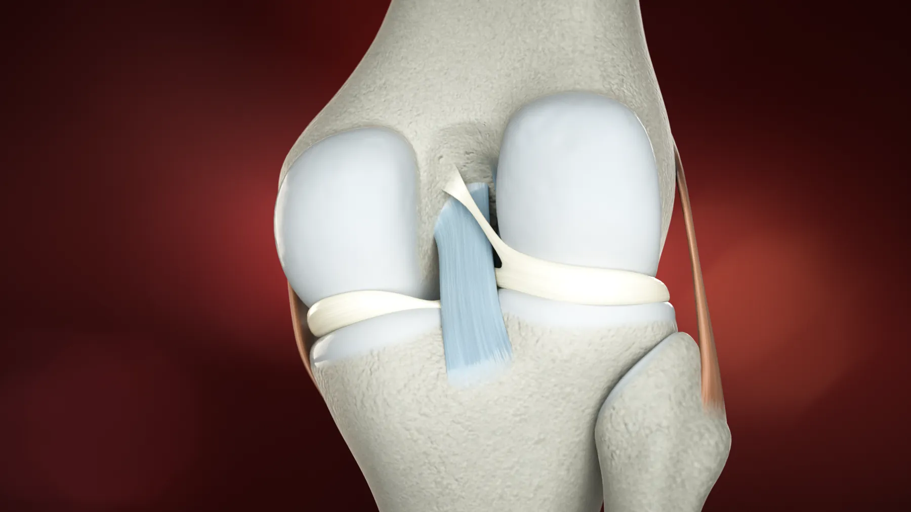 Tendoplus ACL Therapy — image 4
