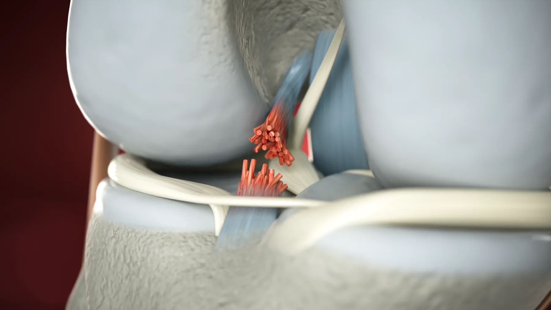 Tendoplus ACL Therapy — image 5