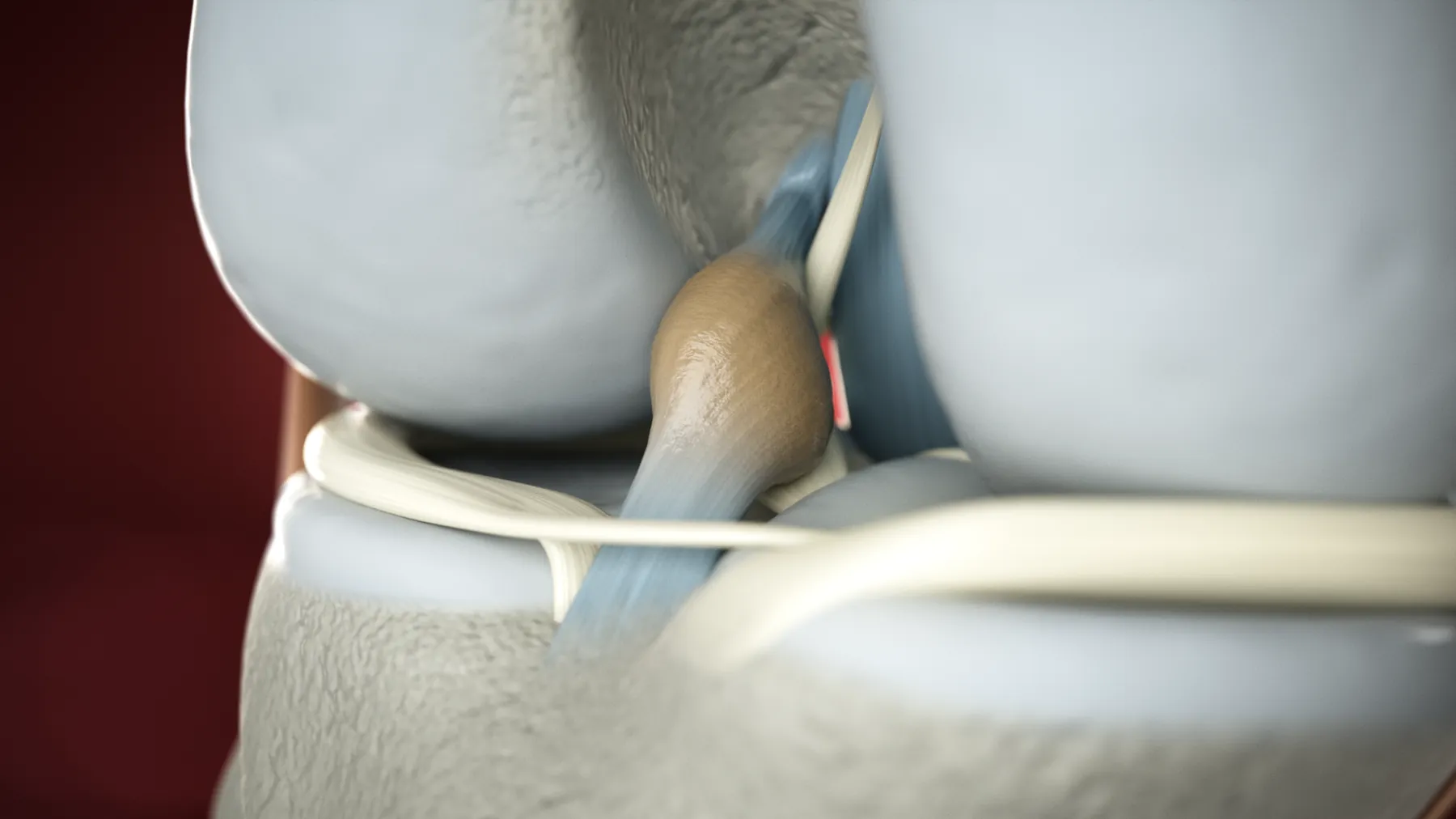 Tendoplus ACL Therapy — image 7