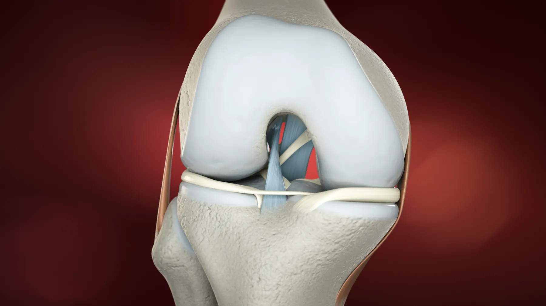 Tendoplus ACL Therapy